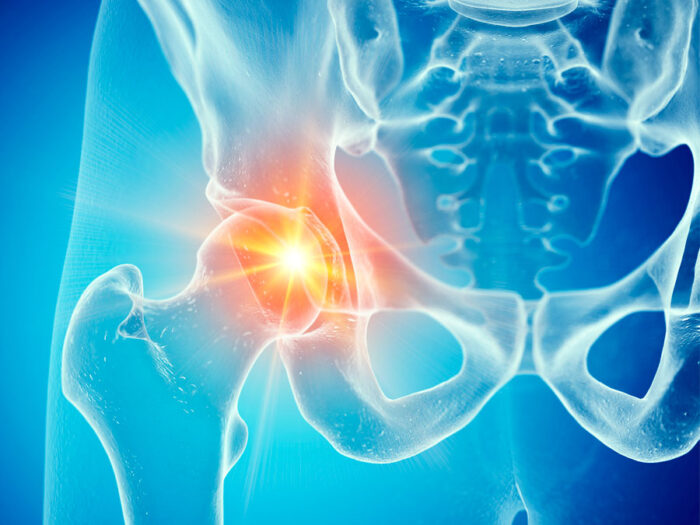 artrosi_anca_terapia_cna