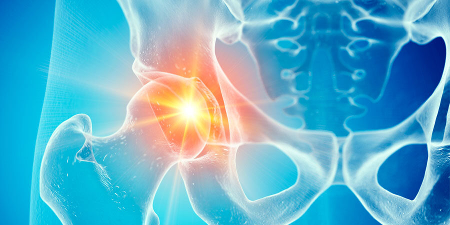 artrosi_anca_terapia_cna